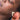 nodular acne, facial scars, acne before and afters, ice pick scars, pimple scars, facials for acne near me, acne extraction, benzoyl peroxide before and after