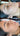 nodular acne, facial scars, acne before and afters, ice pick scars, pimple scars, facials for acne near me, acne extraction, benzoyl peroxide before and after