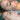 nodular acne, facial scars, acne before and afters, ice pick scars, pimple scars, facials for acne near me, acne extraction, benzoyl peroxide before and after