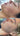 nodular acne, facial scars, acne before and afters, ice pick scars, pimple scars, facials for acne near me, acne extraction, benzoyl peroxide before and after