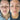 nodular acne, facial scars, acne before and afters, ice pick scars, pimple scars, facials for acne near me, acne extraction, benzoyl peroxide before and after