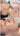 nodular acne, facial scars, acne before and afters, ice pick scars, pimple scars, facials for acne near me, acne extraction, benzoyl peroxide before and after
