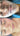 nodular acne, facial scars, acne before and afters, ice pick scars, pimple scars, facials for acne near me, acne extraction, benzoyl peroxide before and after