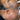 nodular acne, facial scars, acne before and afters, ice pick scars, pimple scars, facials for acne near me, acne extraction, benzoyl peroxide before and after