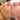 nodular acne, facial scars, acne before and afters, ice pick scars, pimple scars, facials for acne near me, acne extraction, benzoyl peroxide before and after